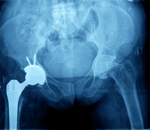 Hip Replacement