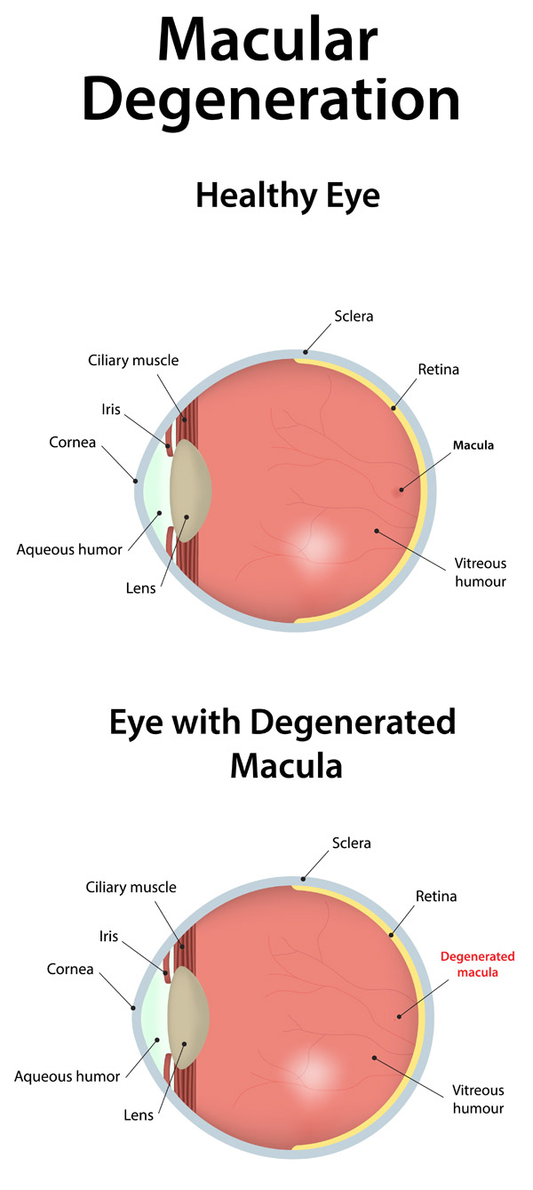 Macular Degeneration